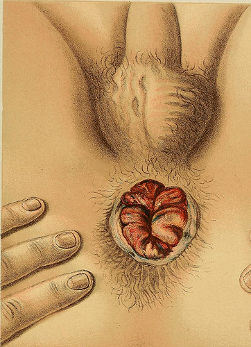 Image from page 490 of „Diseases of the rectum and anus: designed for students and practitioners of medicine“ (1910)